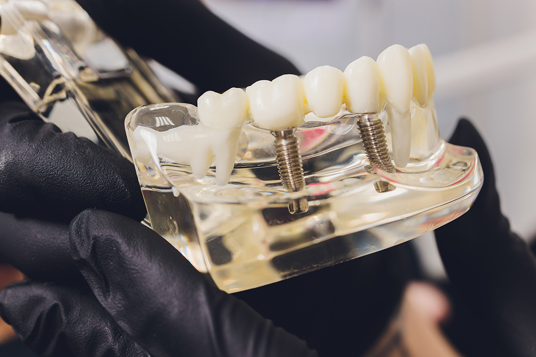 Implantologia y protesis dental Paciente mostrando su nueva sonrisa tras un tratamiento de implantes dentales.