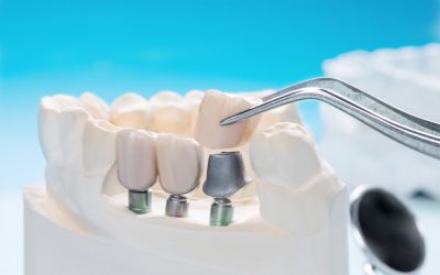 Estas Navidades, presume de sonrisa con Clínica Dental Pedraza: blanqueamiento, revisión e implantes dentales